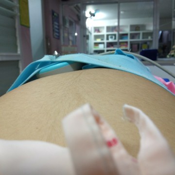 31+1 เกือบเสียลูกไปเพราะถ่ายบ่อย