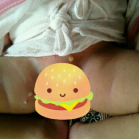 benjolan bernanah pada bayi