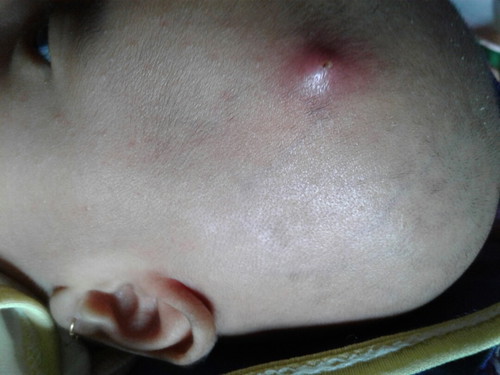 beenjolan di kepala bayi