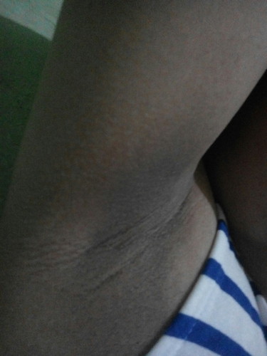 dark underarm