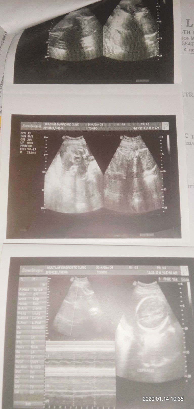 ultrasound result
