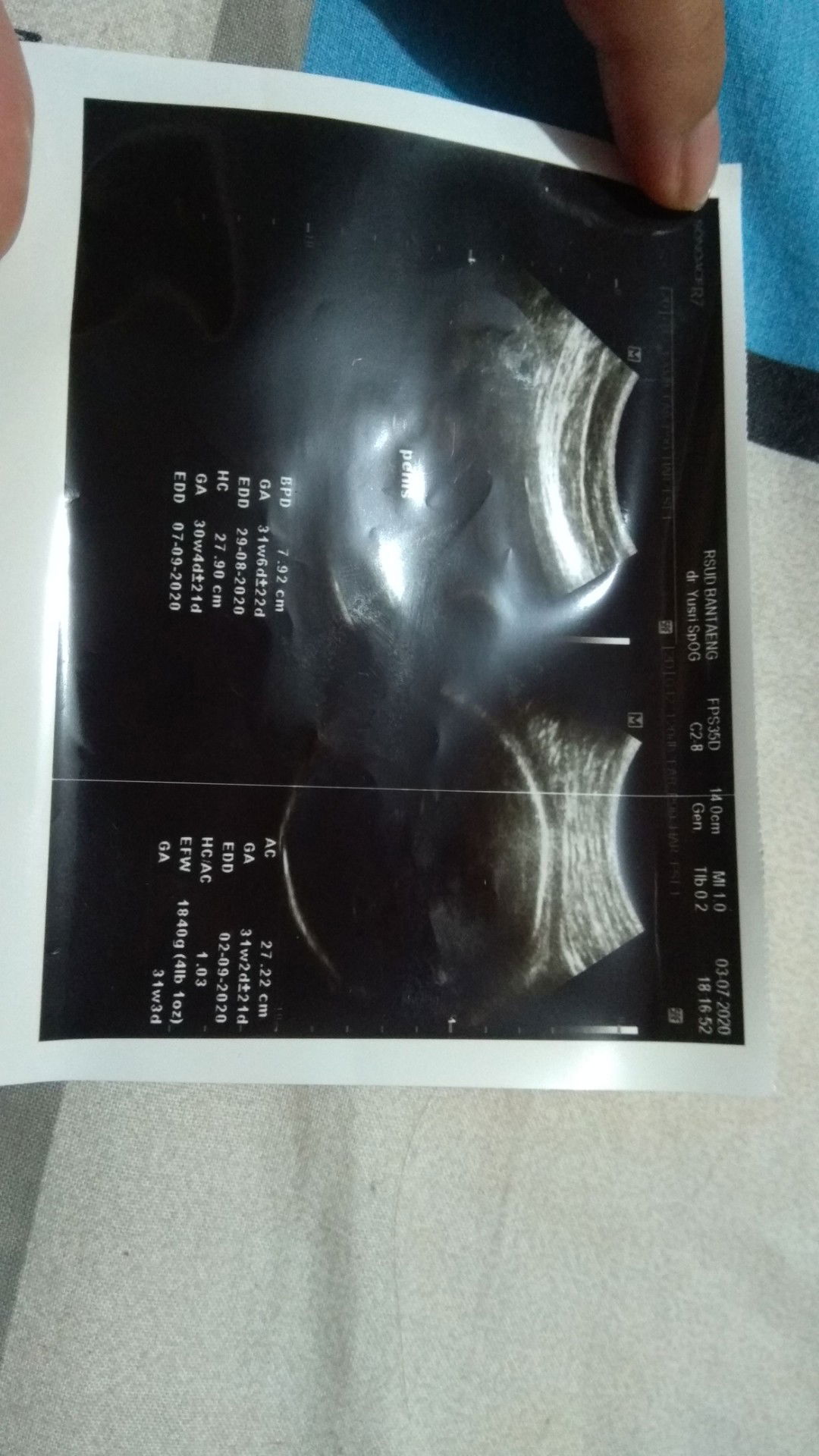 BB janin saya normal atau kekecilan?