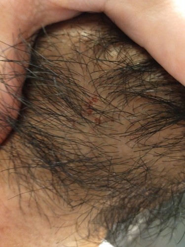 hii may derma ba dito or same case?