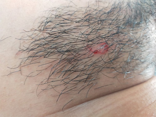 may derma ba dito or same case?? help pls!!