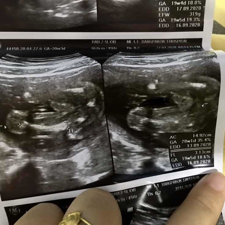 อันตร้าซาวด์เพศลูกแม่ๆช่วยดูหน่อยค่ะ