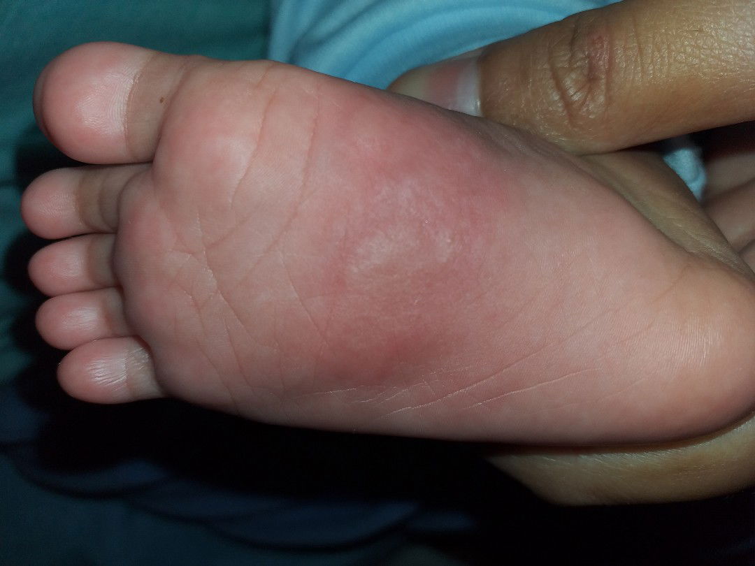 Terkena gigitan serangga atau alergi