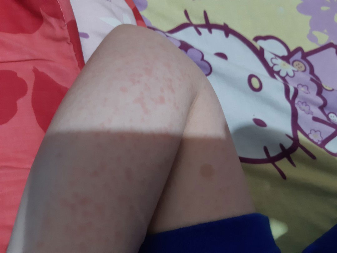 gatal gatal saat hamil 7 bulan