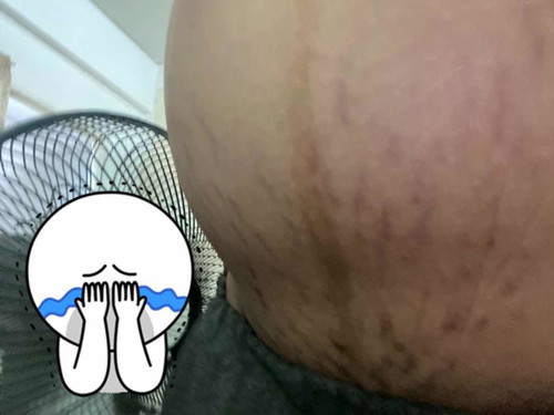 ท้องแตกลายแบบนี้คลอดแล้วจะหายไหมคะ