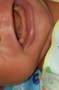 Gusi bayi warna kuning