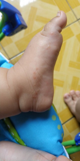 Bintik berisi air pada kaki bayi