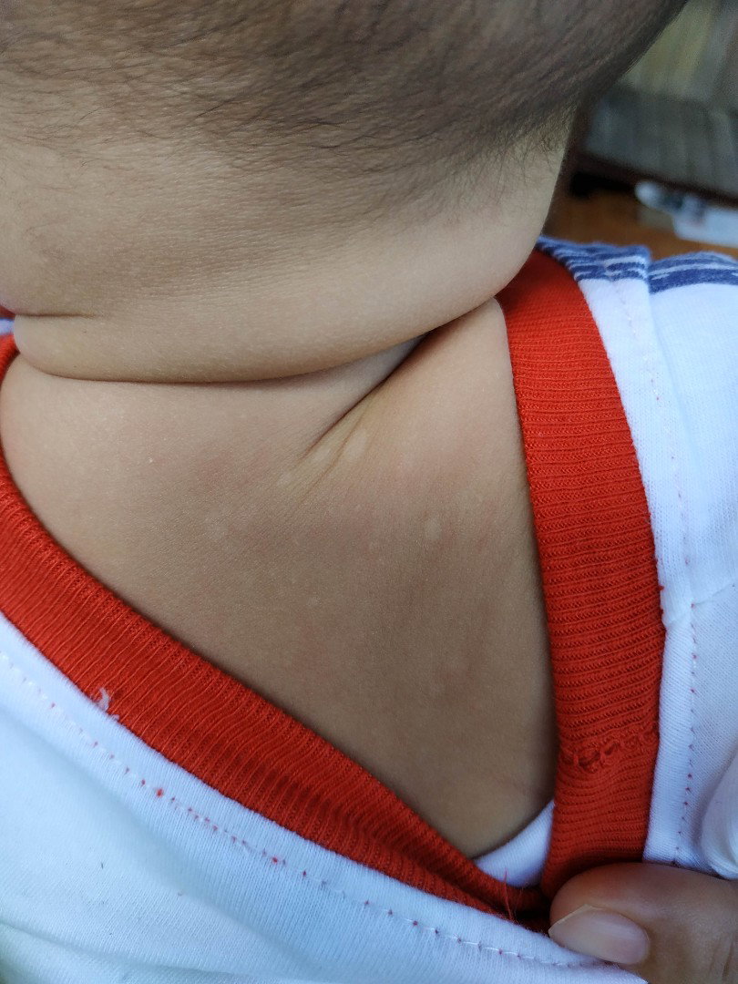 Bercak putih pada tubuh bayi