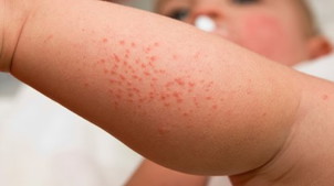 How to get rid of heat rash in kids