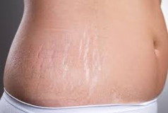 Is it too late to get rid of stretch marks?