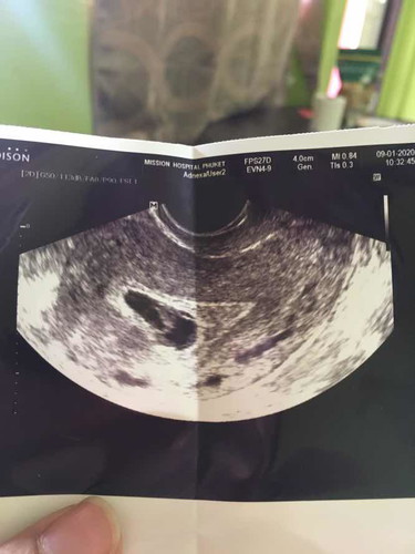 รบกวนสอบถามหน่อยคะ. พอดีมีเลือดสดออก แต่ไม่ปวดท้อง. พอไปหาหมอ. หมอ อันต้าซาว ก็บอกว่านอกรกมีแต่เลือด. มีแม่คนไหนเคยเป็นเปล่าคะ. แล้วสุดท้ายแท้งเปล่าคะ ตอนนี้8 สัปดาห์