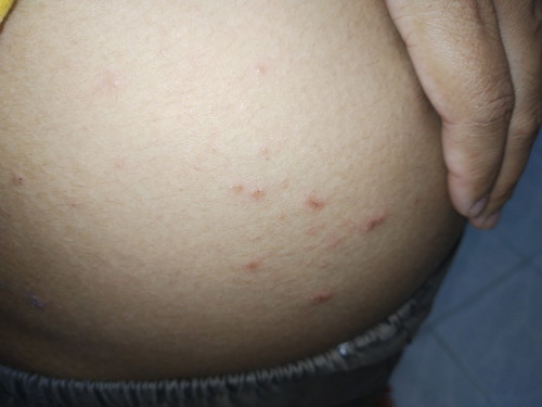 ผื่นคันที่หน้าท้อง