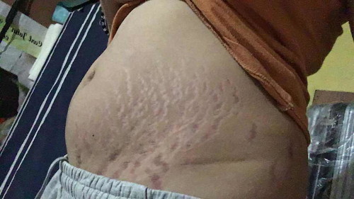 Stretchmark