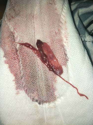 Menstruation abnormalities