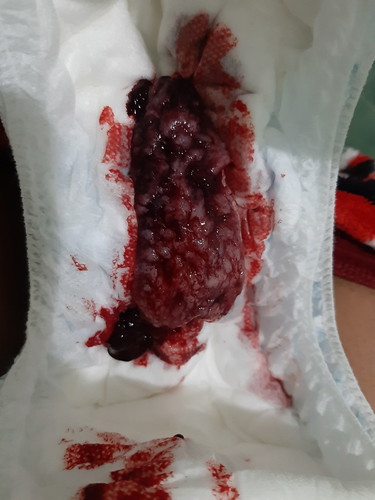 Ectopic Pregnancy