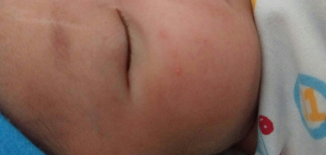 Masalah Kulit Bayi