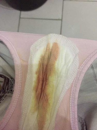 Discharge ?