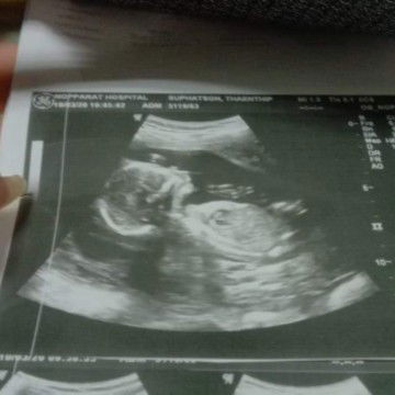 แชร์ประสบการณ์การตรวจครรภ์