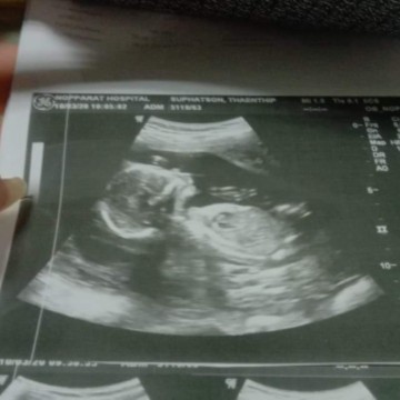 แชร์ประสบการณ์การตรวจครรภ์