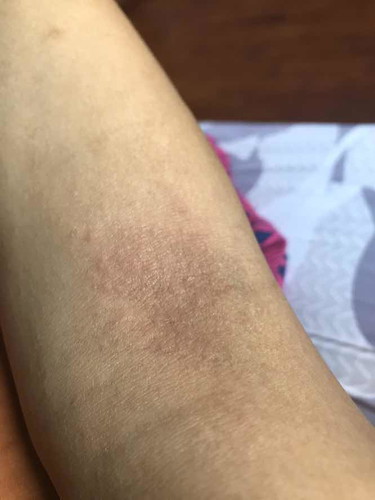 rash during pregnancy