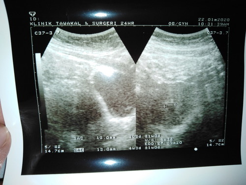 Ada Spotting Setiap Kali Buang Air Kecil