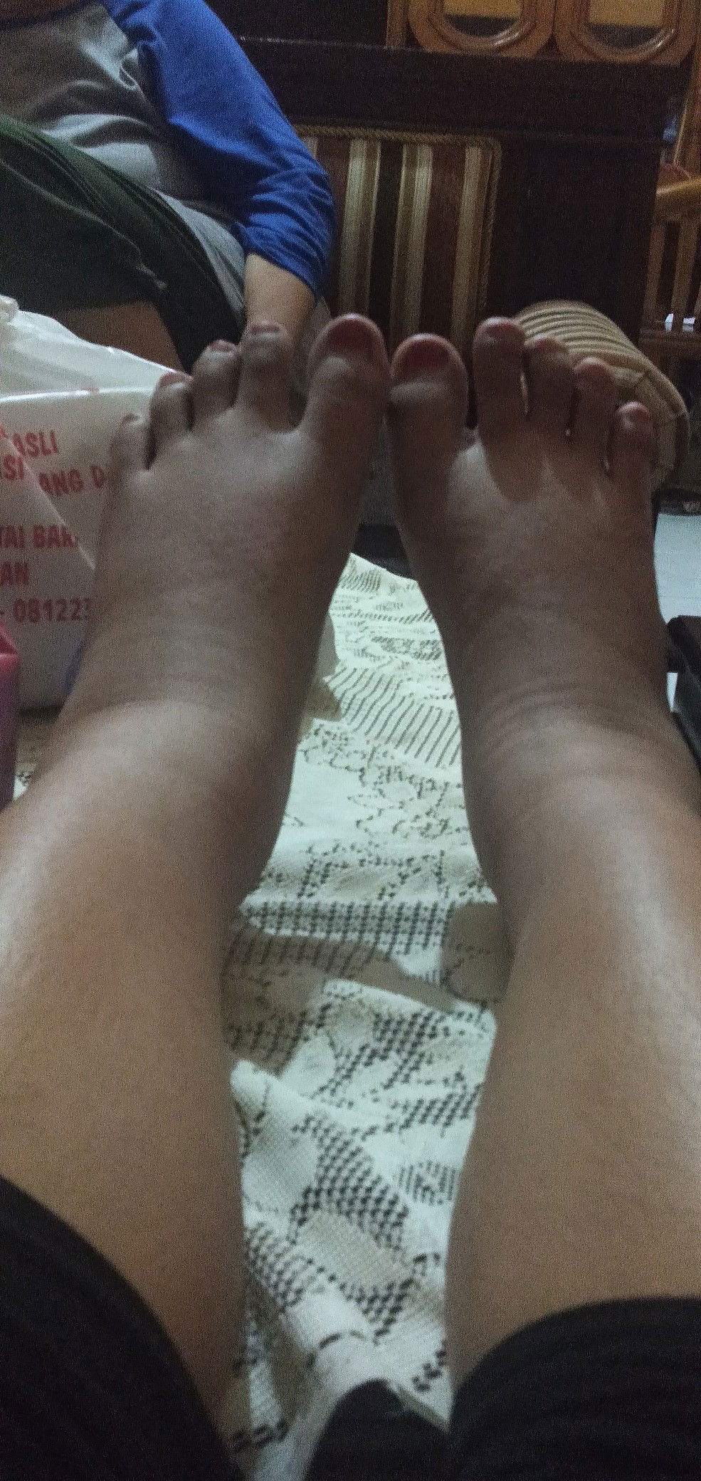 KAKI BENGKAK ABIS MUDIK