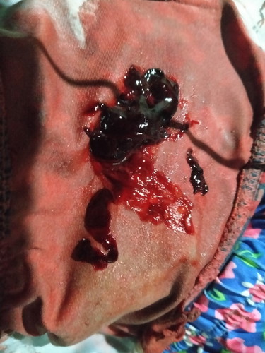 Vaginal Bleeding