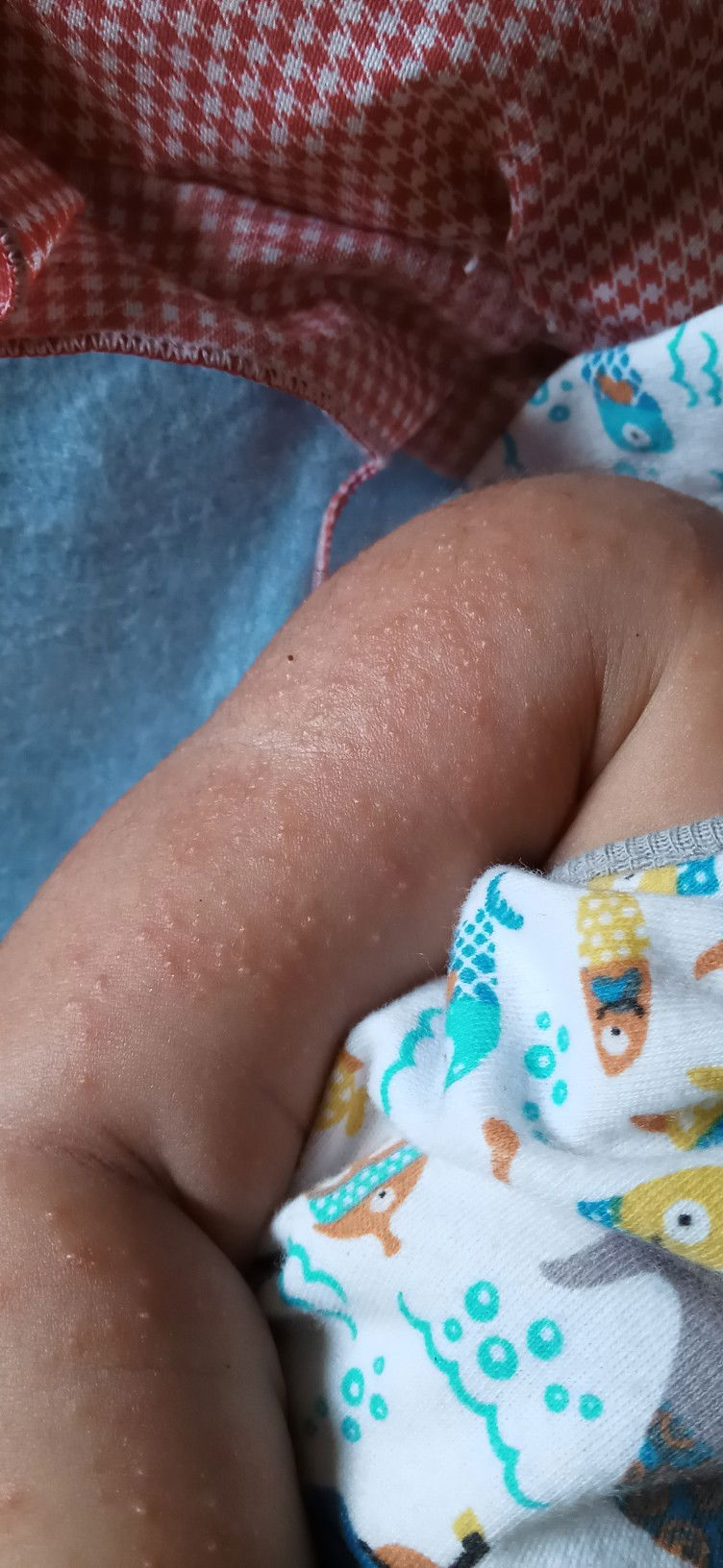 Biang keringat atau apa ?