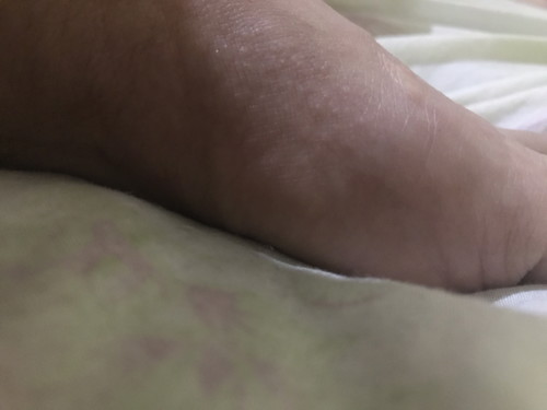 Itchy