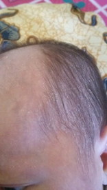 share bun.. gejala kulit bayi