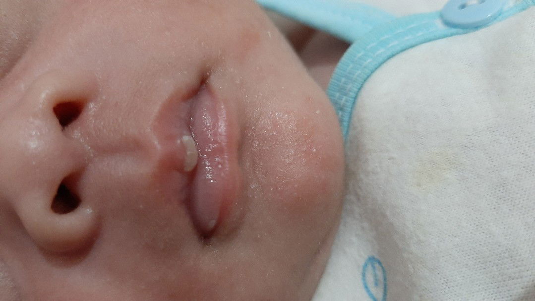 bibir bayi ada benjolannya