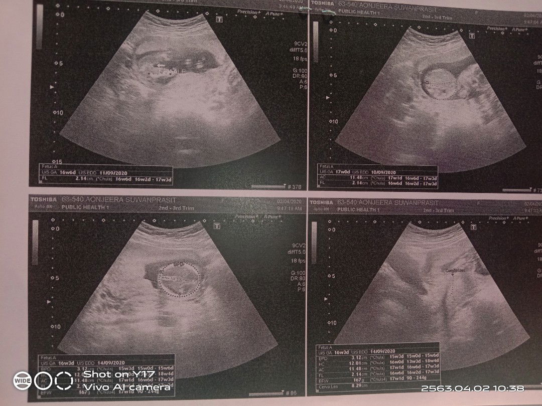 คุณแม่ท่านไดได้ตรวจคัดกรองดาวน์อายุ37บ้างเราอายุ37มีลูกคนที่2คุณหมอไม่ตรวจคัดกรองดาวน์ให้เนื่องจากกลัวโรคโควิดและกลัวว่าถ้าตรวจอาจเสี่ยงกับการติดเชื้อได้เรามีความกังวนนิดหน่อยกลัวลูกสาวเป็นดาวน์ของเสียงแม่ที่ไม่ได้คัดกรองดาวน์หน่อยนะคะ