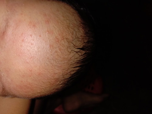 Rashes