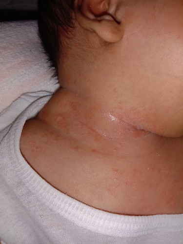 Rashes