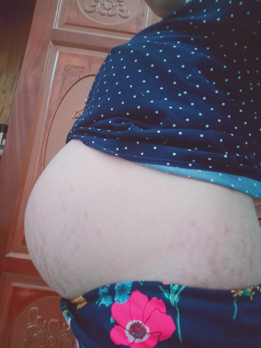 tụt bụng