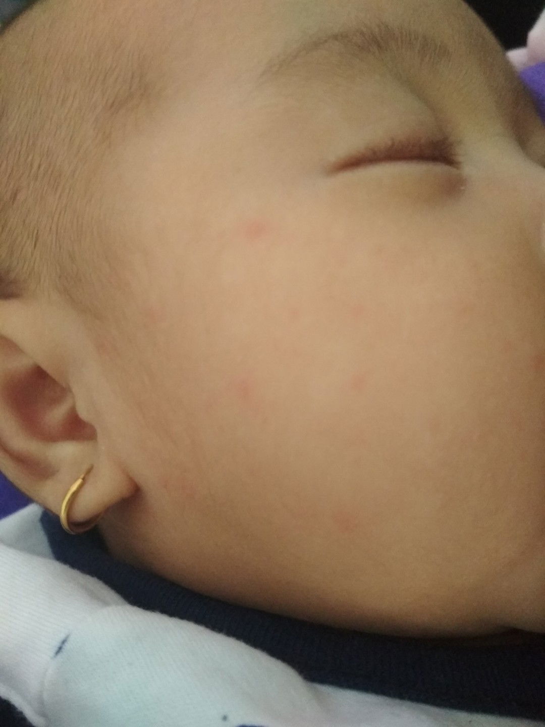 kulit bayi beruntusan