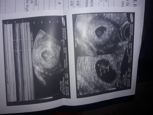 Nagbago yung EDD ko??