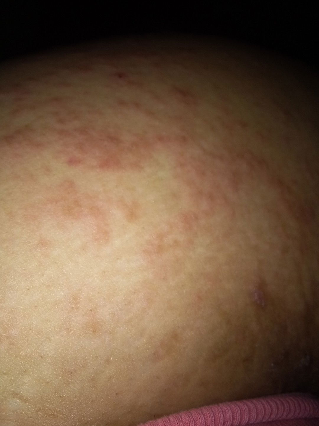 skin rash at 22 weeks..