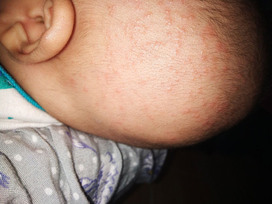 bintik merah di kepala baby