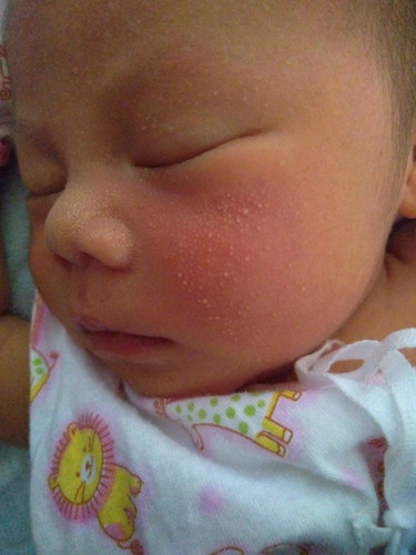 น้องเป็นผื่น