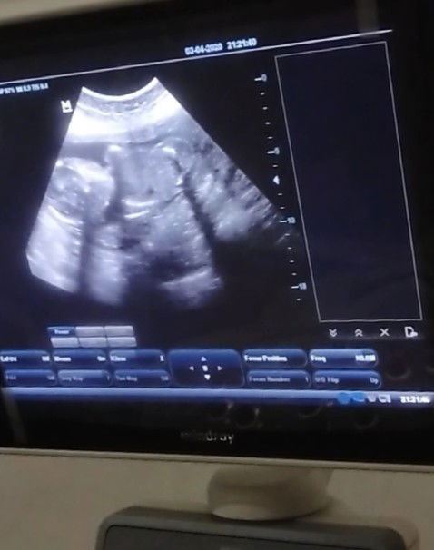 Preklamsia terulang lagi ? Solusi ?