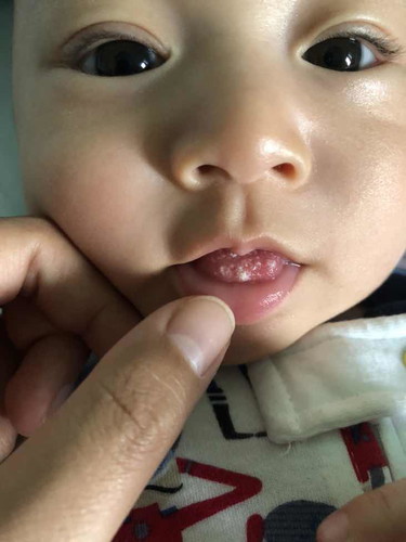 ลิ้นน้องเป็นอะไร??