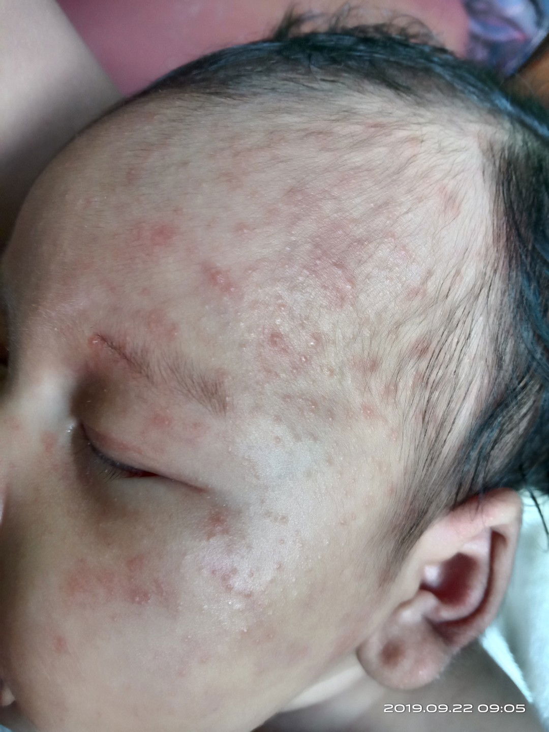 bintik bintik merah diwajah