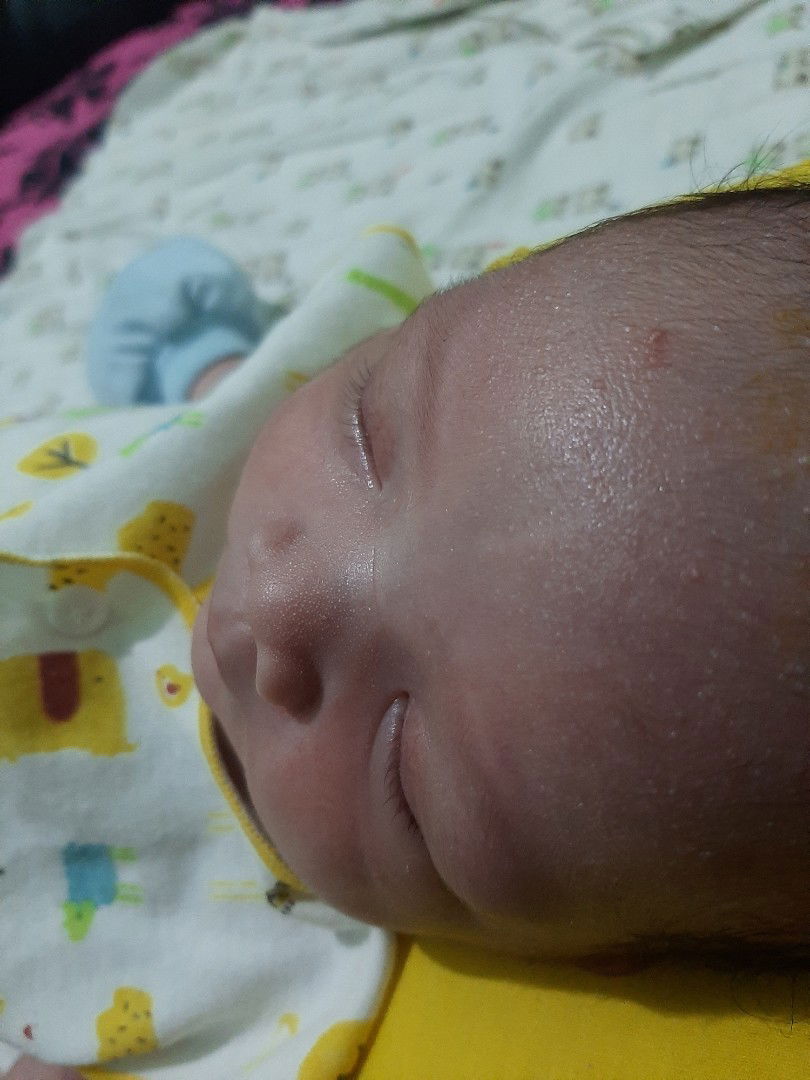 beruntus pada dahi dan rambut