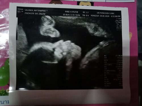 หมอบอก น้องมีดั้งนะ นิดนึ่ง