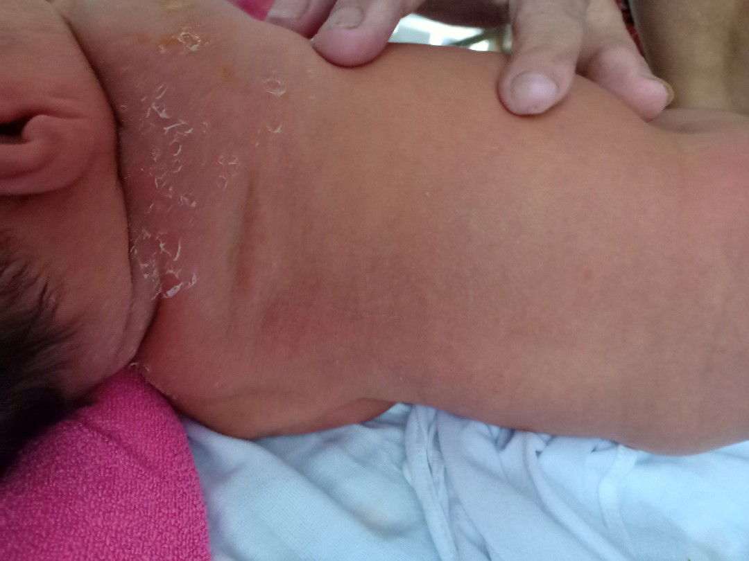 bé bị tróc da lưng