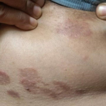 gatal2 d bwah payudara